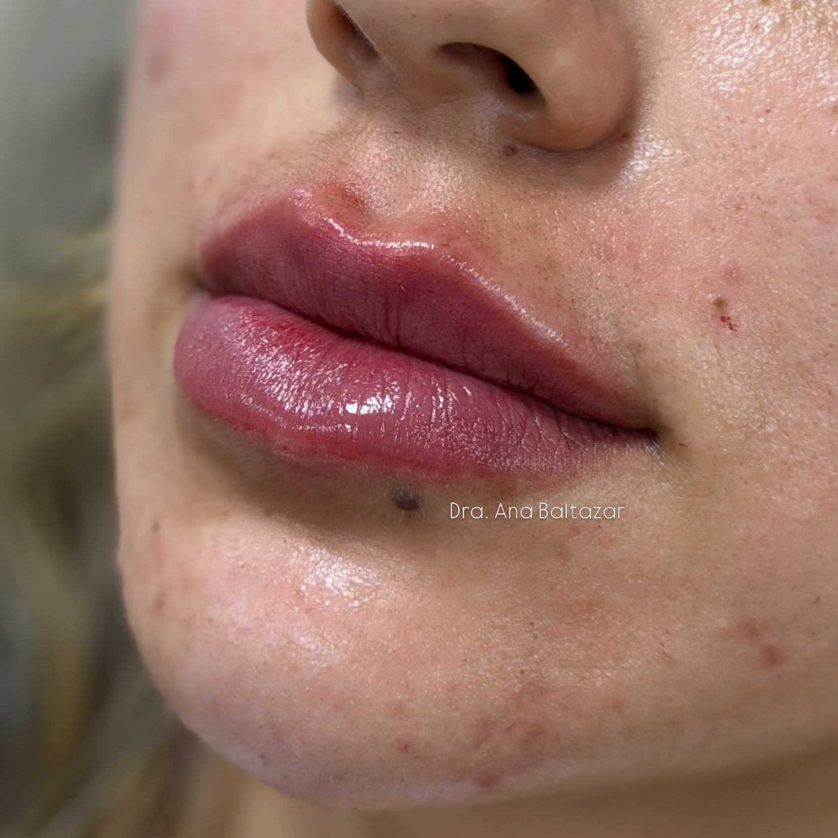 Harmonização facial — Heaven Clinic