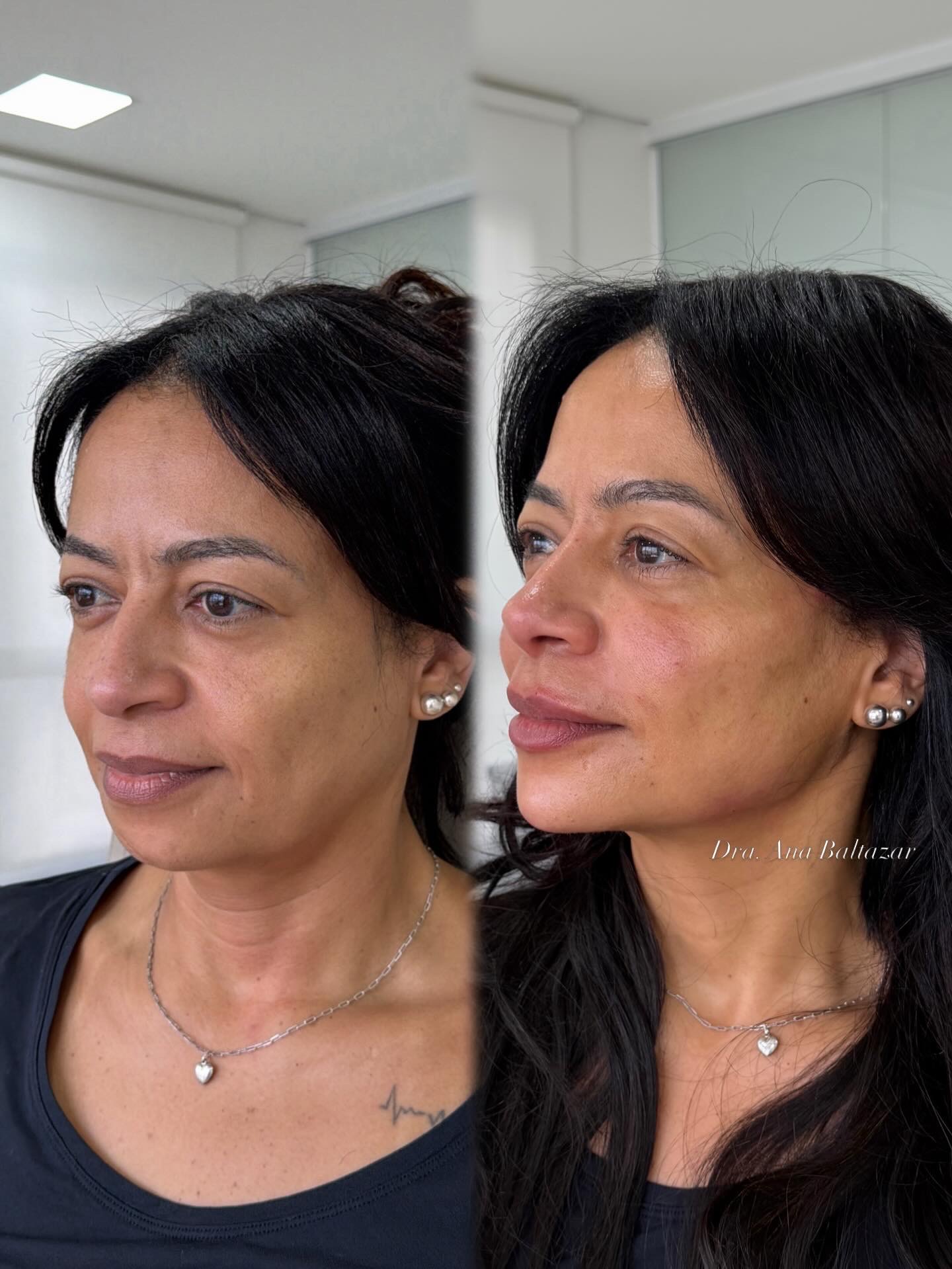 Tratamento estético — Dra. Ana Baltazar