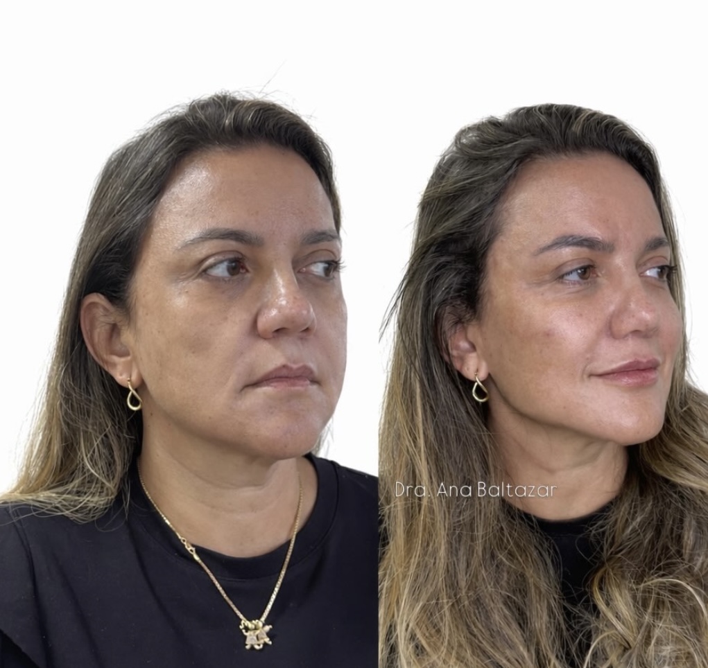 Resultado de tratamento estético — Heaven Clinic