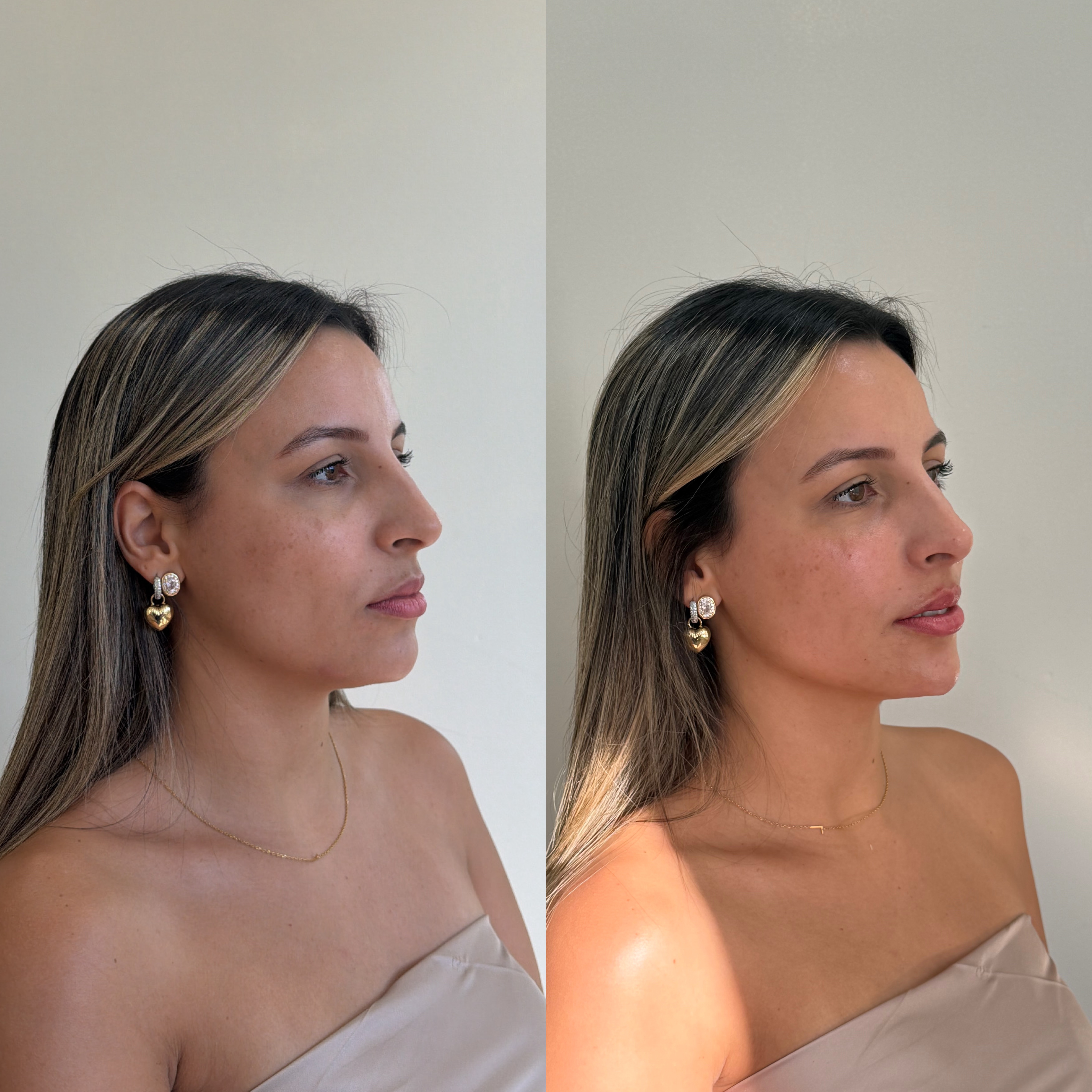 Resultado estético corporal — Dra. Ana Baltazar